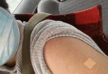 第二波まっただ中でのコロナワクチン接種 ~体験者に聞く~ ワクチン接種後。局部が腫れるということはなかったという。Photo © The Vancouver Shinpo