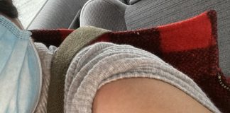 カナダ、アストラゼネカ社ワクチンを承認 ワクチン接種後。局部が腫れるということはなかったという。Photo © The Vancouver Shinpo